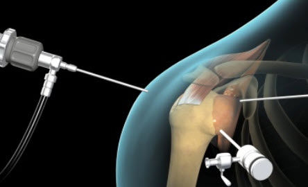 Robot surgery animation image of shoulder